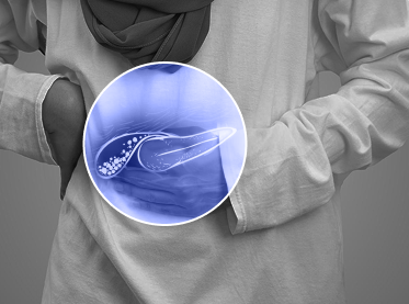 Gall Bladder Stone & Billiary Disease